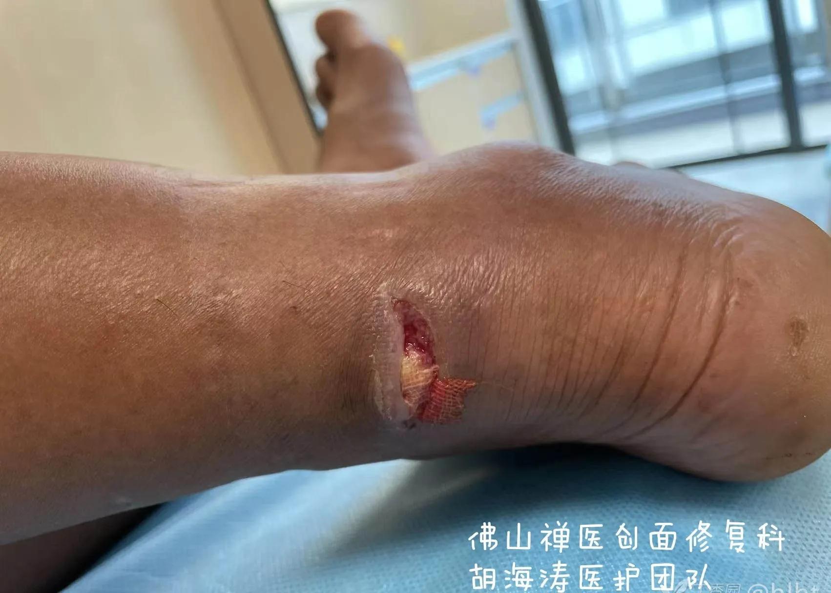 农民工伤口发炎怎么赔偿