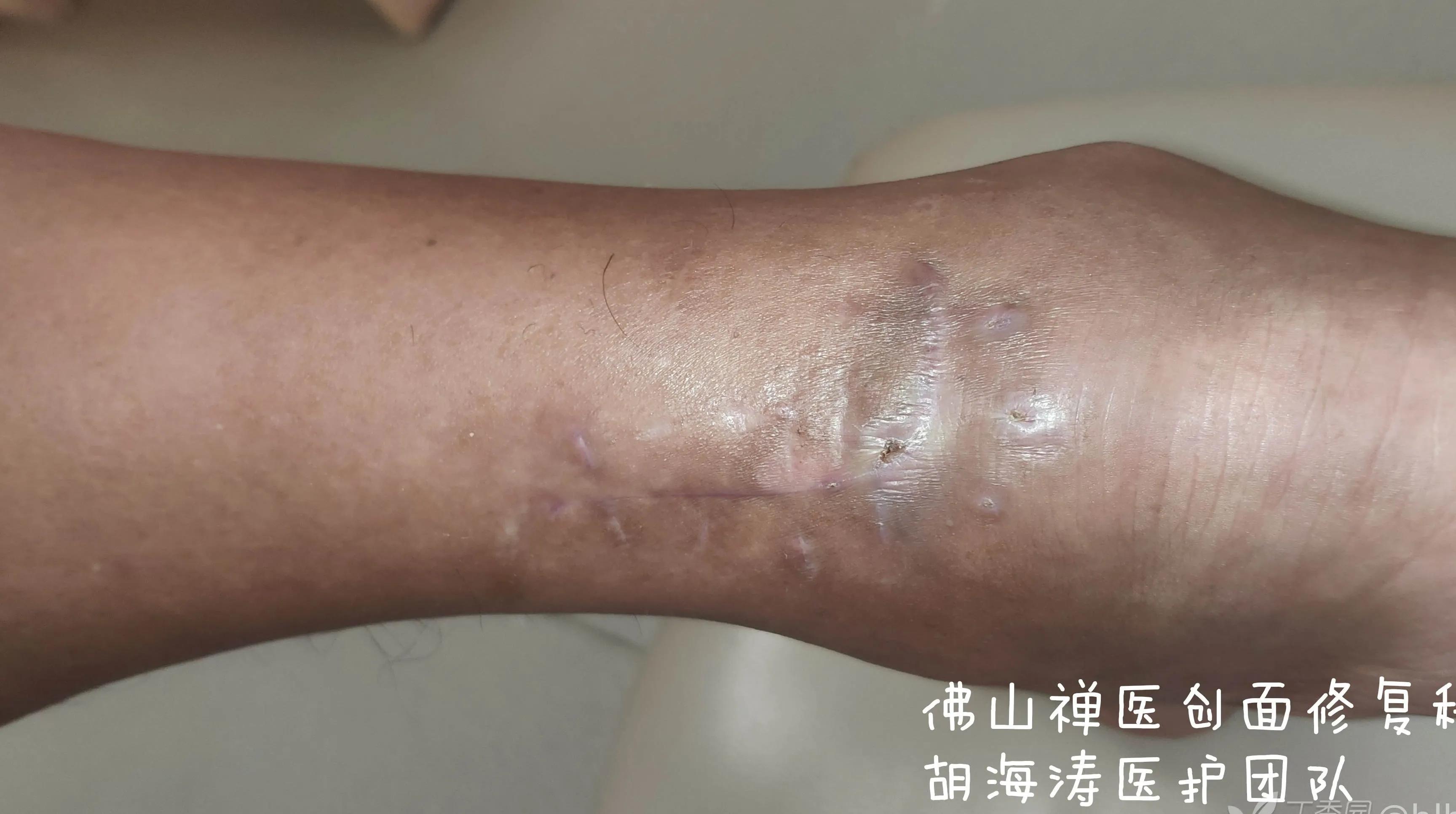 农民工伤口发炎怎么赔偿