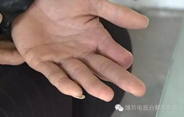 对农民工工伤断指怎样赔偿